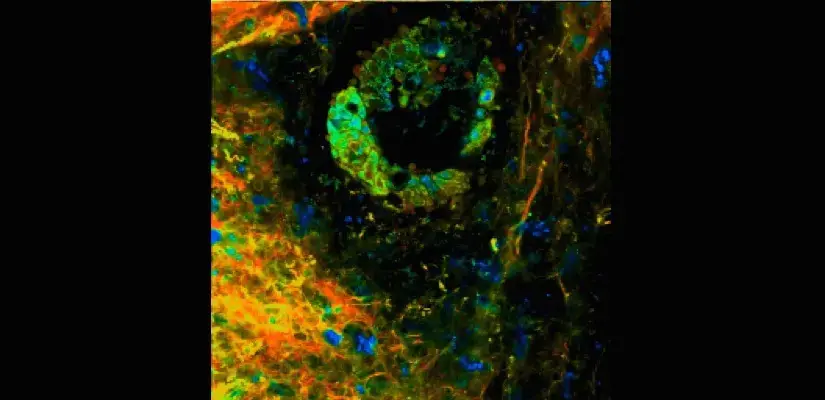pancreatic cancer tissue