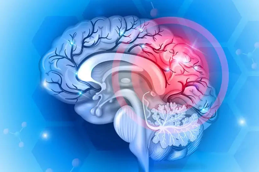 brain concussion