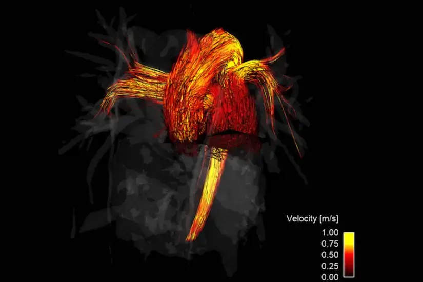blood flow MRI