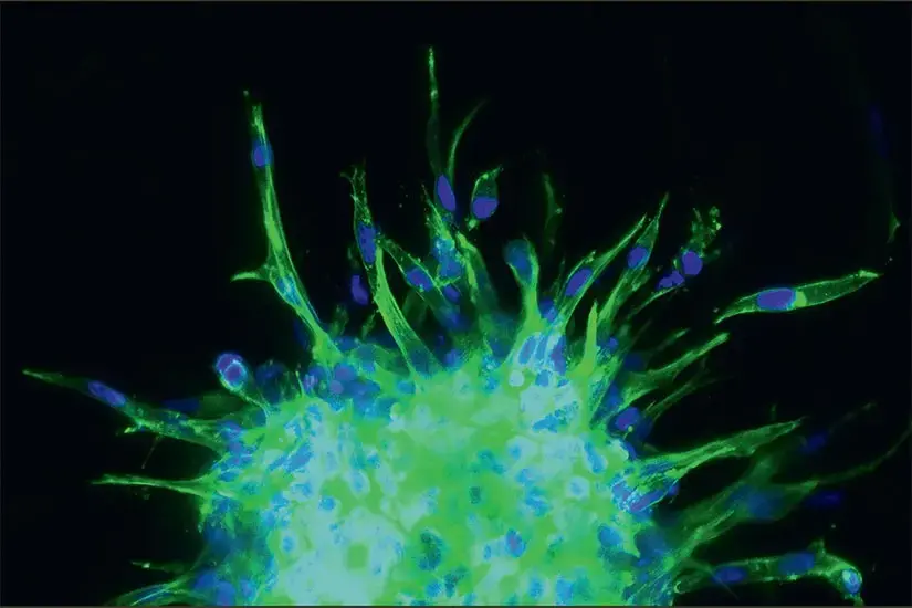 breast cancer cells